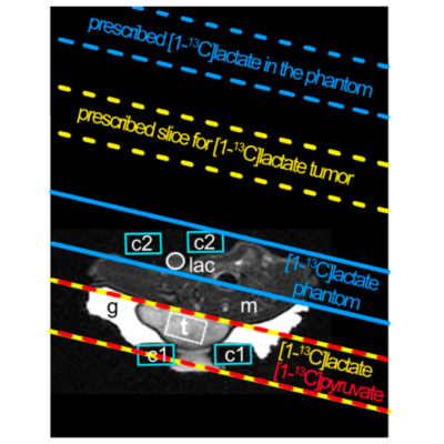 Hyperpolarized 13C Spectroscopy with Simple Slice-and-Frequency-Selective Excitation