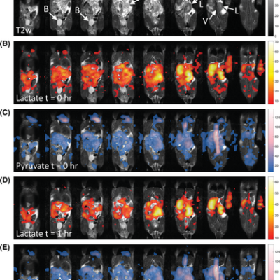 3D bSSFP for hyperpolarized 13C MRI