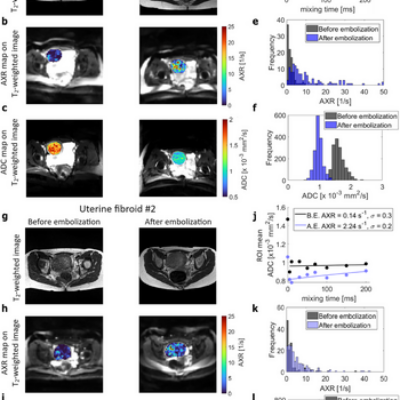 New Paper: Early Detection of Cell Death Using MRI